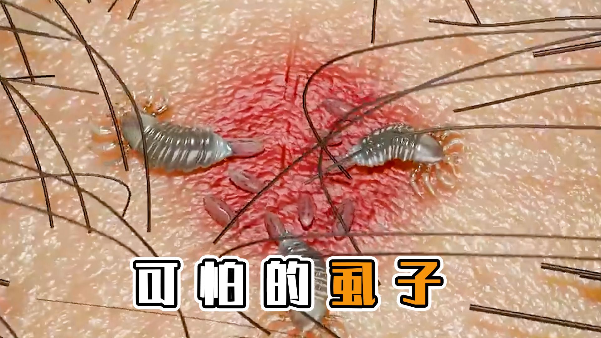 为何30年前男女老少都有虱子,现在没有了?虱子是哪...