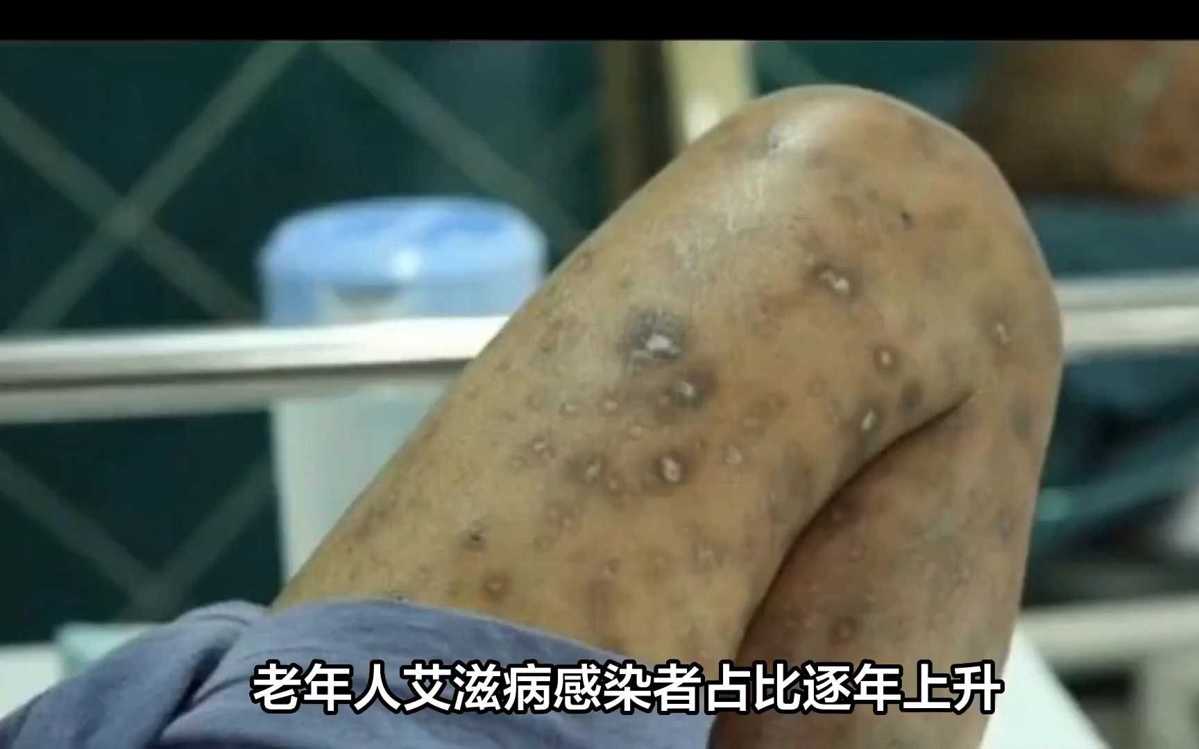 艾滋病到底是怎么来的？第一个艾滋病人又是怎么感染的？