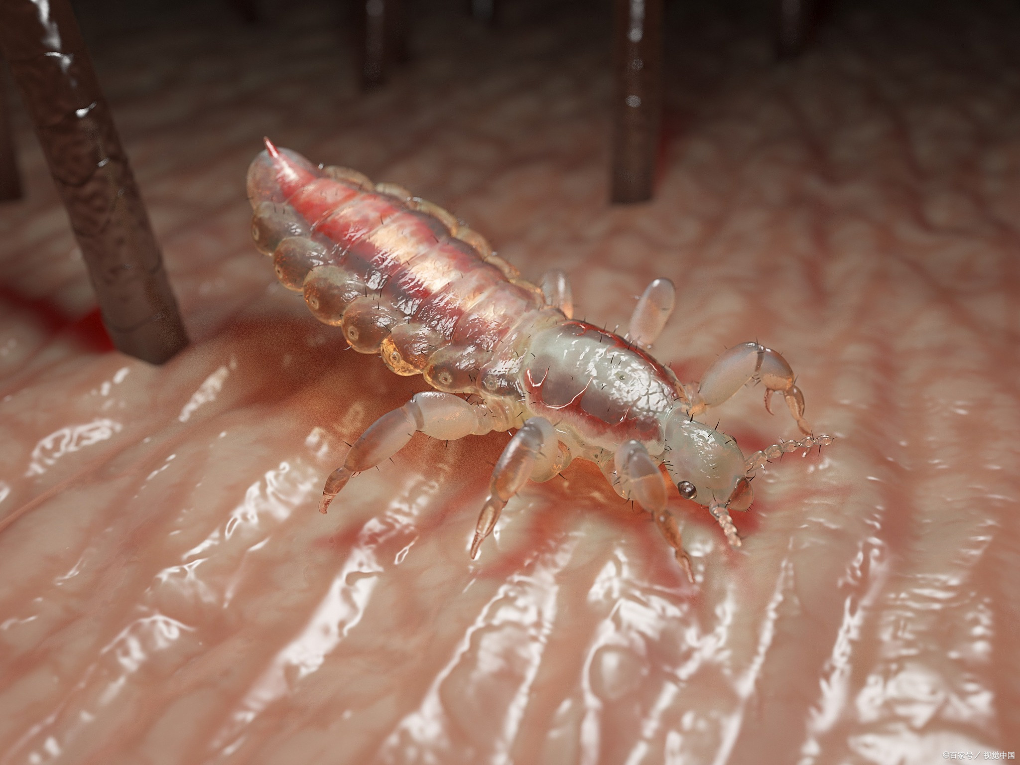 虱子消失的原因 虱子为何现在不见了