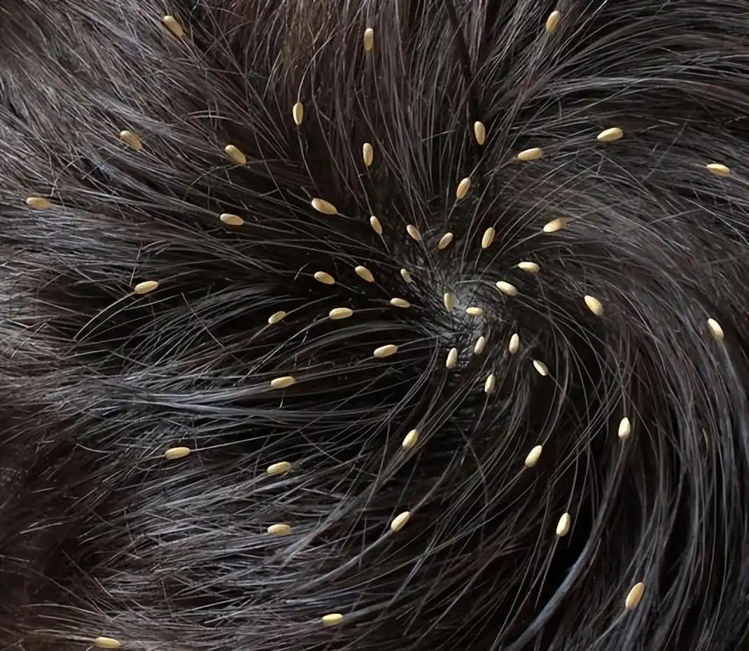 为什么30年前农村人人都有虱子，而现在却几乎看不到了？