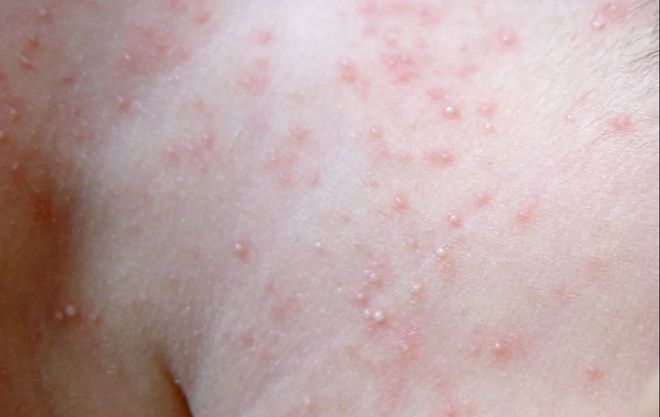 现在的过敏宝宝为什么这么多？...