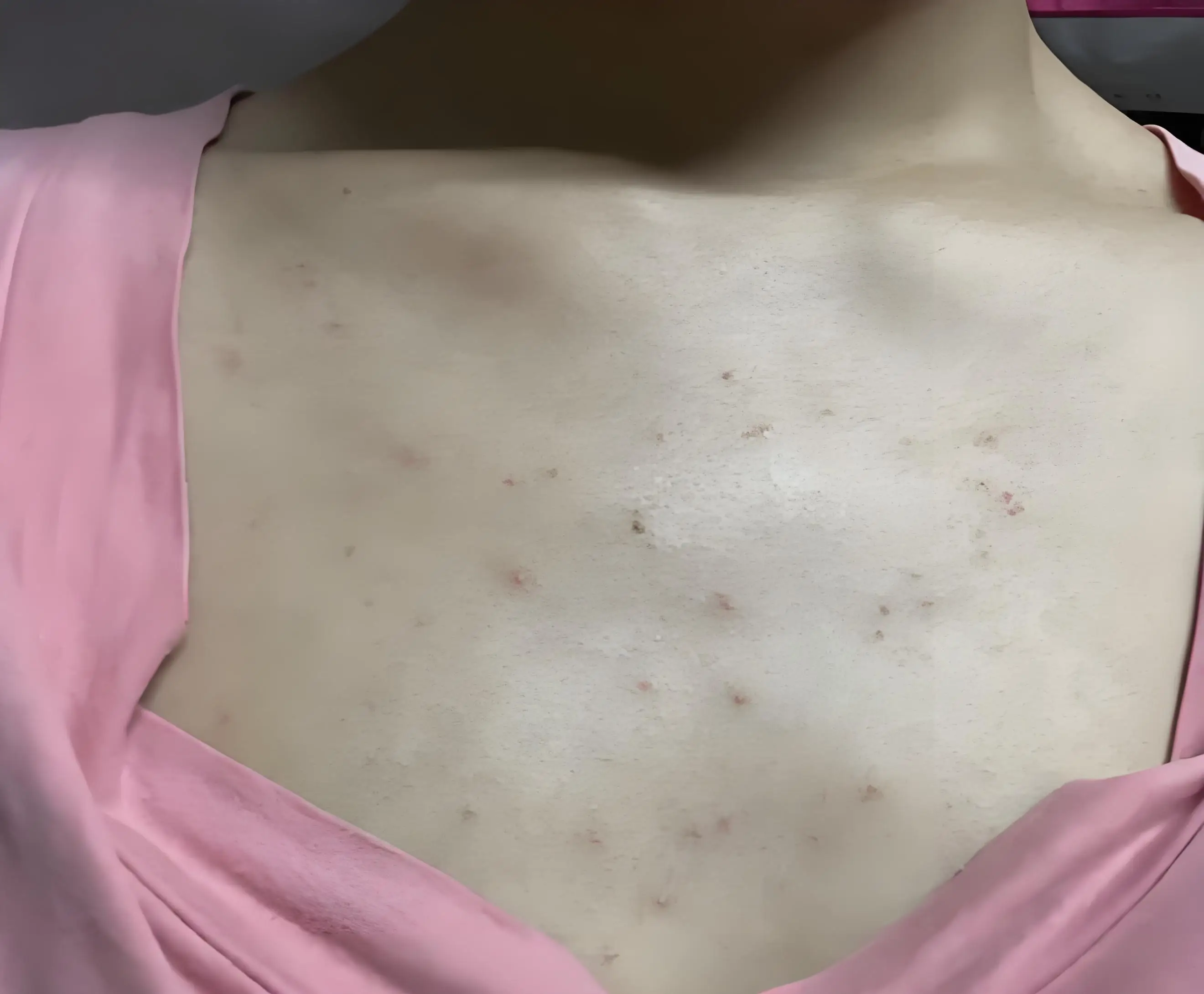 过敏症状形成原因 中国人常见过敏原有哪些