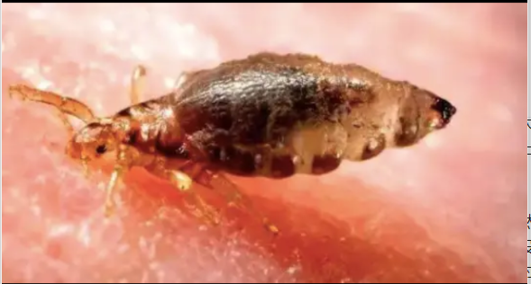 30年前男女老少都长虱子,为什么现在没有了?虱子是...